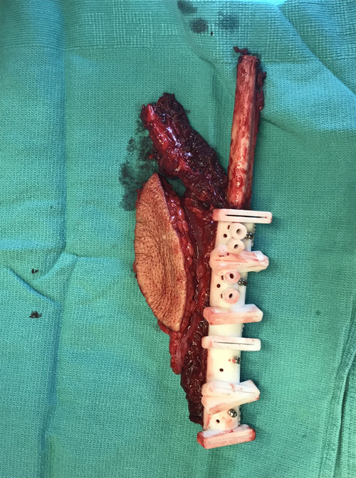 VSP for Patient-Specific Reconstructive Microsurgery Case Study Figure 4b